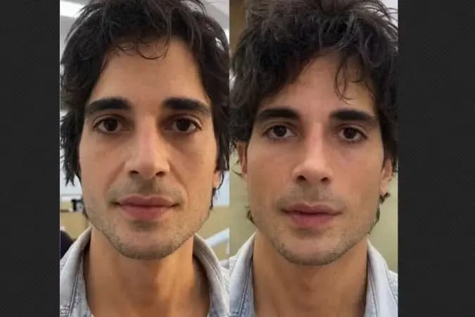 Fiuk faz harmonização facial e surpreende com o resultado do visual